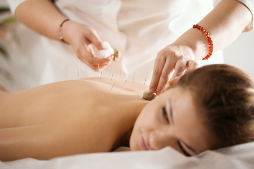 Acupuncture-Treatment-in-Torrance